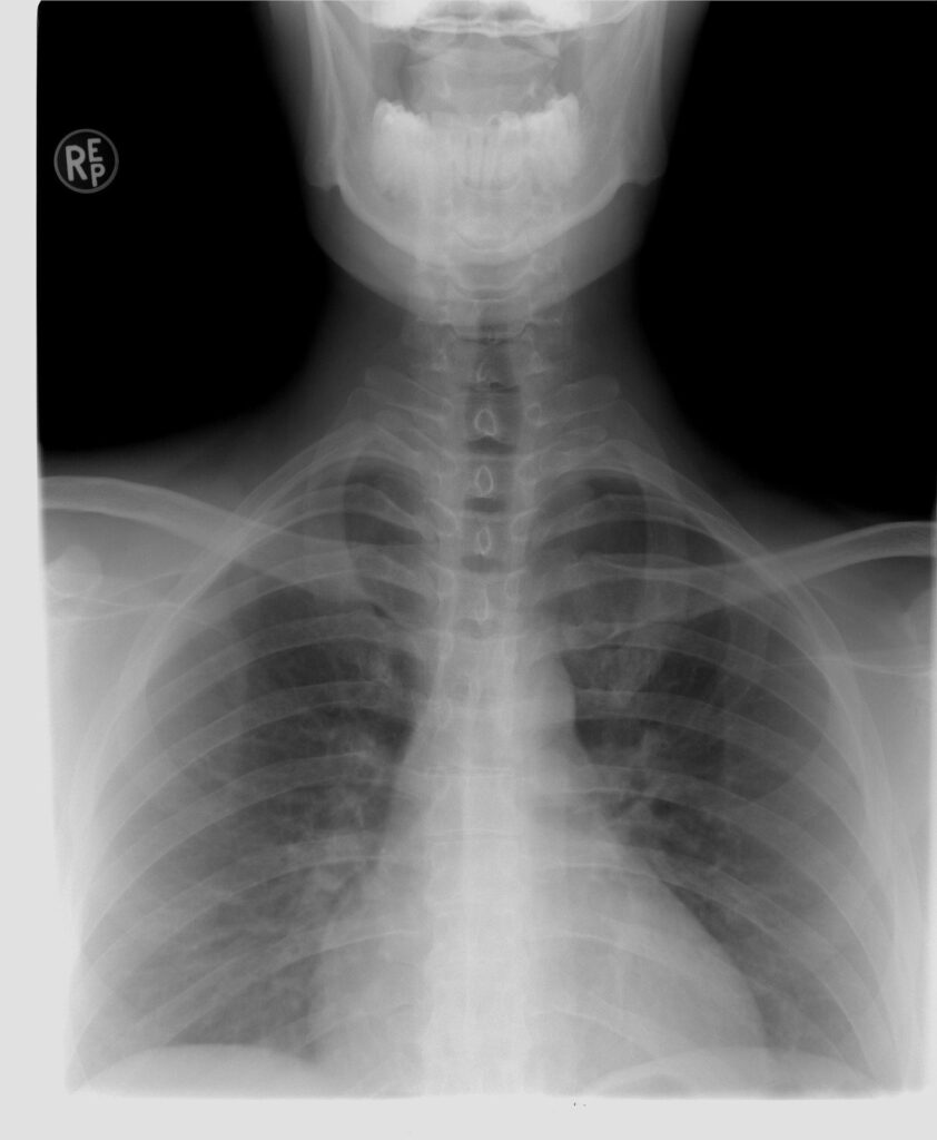 X-Ray