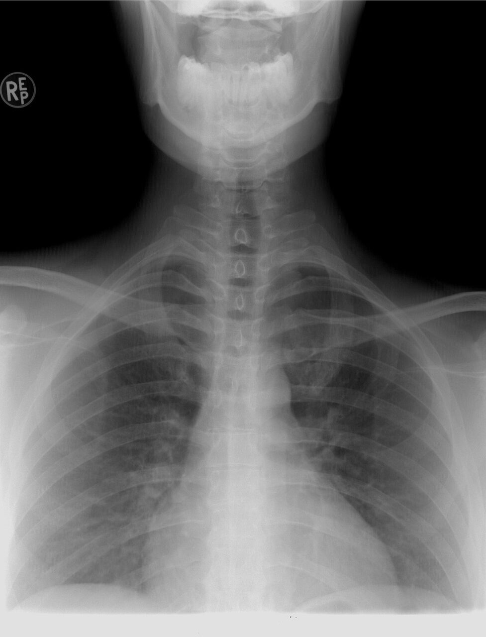 xray, thoracic spine, diagnosis.jpg